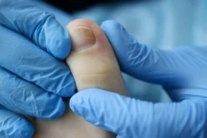 Read more about the article Onycholiza: Przyczyny, Diagnostyka i Regeneracja Paznokci